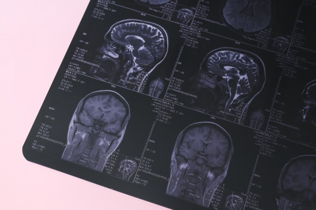 "Overall, our findings suggest that prenatal exposure to PFAS can alter the structural properties of major white matter tracts in the brain."