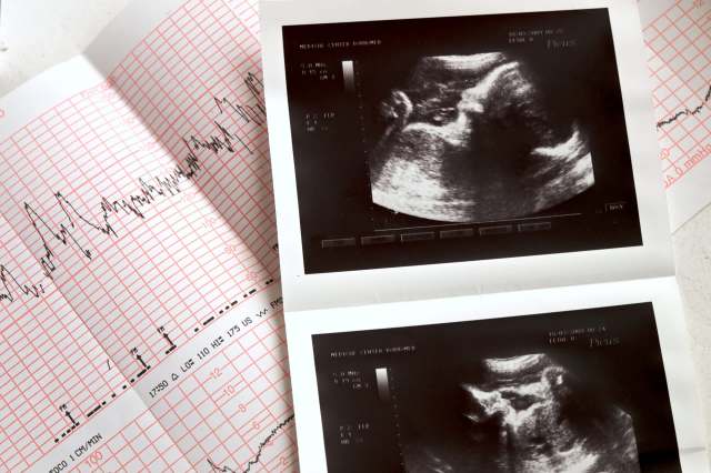"The same jarring imagery of a fried egg could apply to fetal brain development in places with higher-than-recommended levels of ozone."