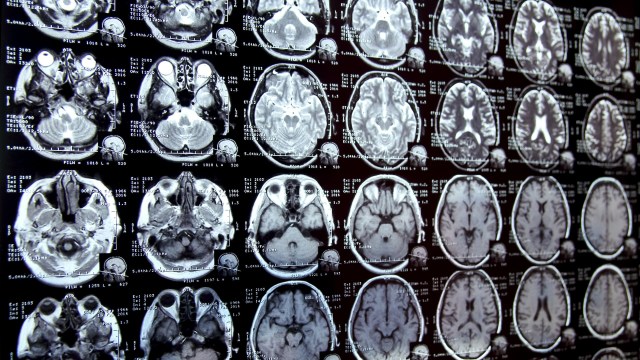 "Now studying tissue from cross-sections of a single brain to find out whether certain regions have higher ... concentrations."