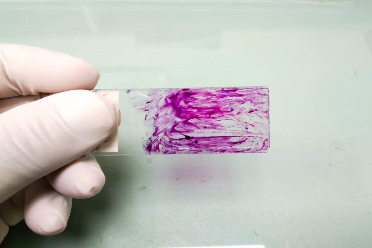 Around 11% of individuals assigned female at birth suffer from endometriosis.