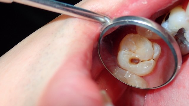 Cavities are still one of the most common health problems on the planet.