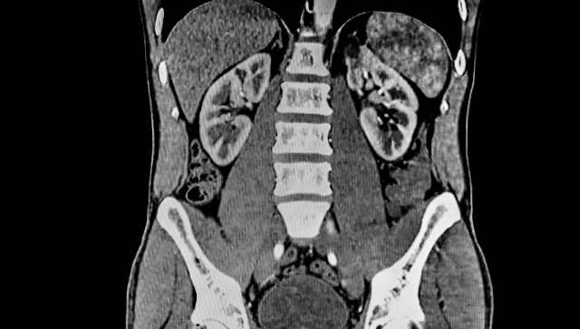 A study from researchers at the University of York revealed that the physicochemical properties of polyamide influence how microplastics are distributed in the body.
