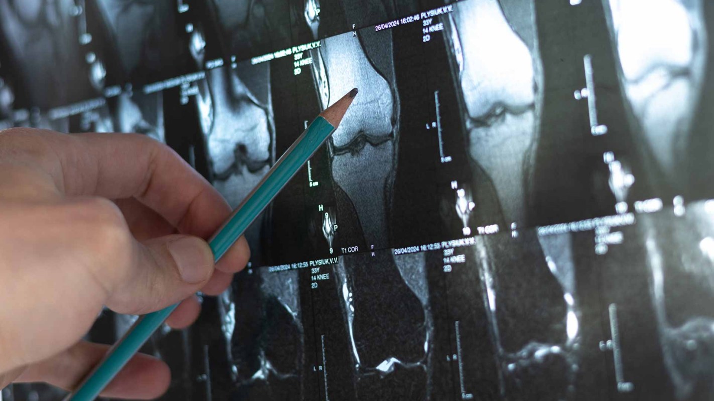 This is important because better bone density reduces the risk of osteoporosis later in life.