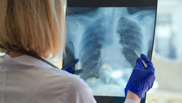 As plastic pollution continues to accumulate globally, scientists are uncovering evidence that the tiniest fragments, called nanoplastics, may harm lung tissue and threaten human health.