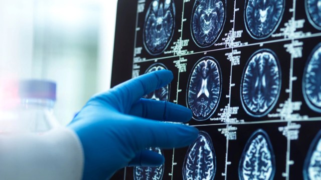 Researchers found a shocking amount of microplastics in the brains of people with dementia.