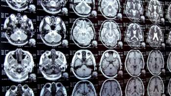 Scientists have detected microplastics and nanoplastics in humans' brains, revealing that plastic moves through the blood and triggers inflammation.