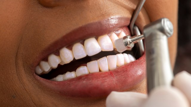 Researchers at the University of Texas at Dallas have developed a new 3D-printing technology for zirconia dental crowns.