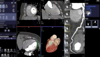 Even low levels of air pollution are linked to more severe heart disease, according to a new study.