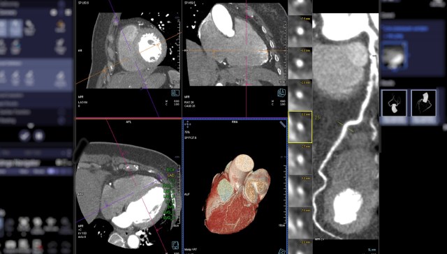 Even low levels of air pollution are linked to more severe heart disease, according to a new study.