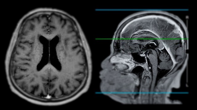 A recent literature review highlights the potential link between microplastics and Parkinson's disease, raising urgent questions.