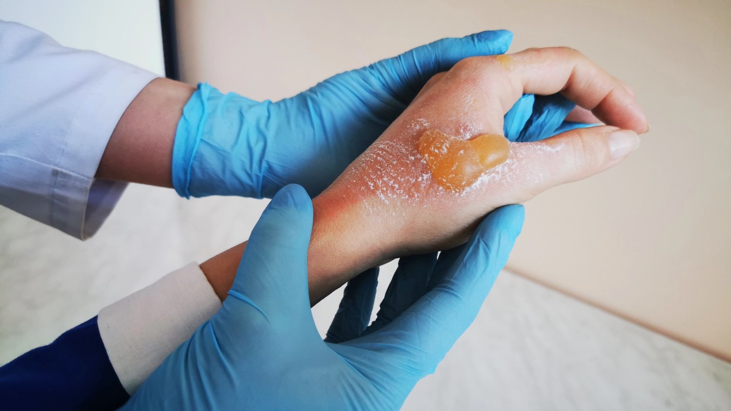 A skin-melting bacteria called Vibrio vulnificus is hitching a ride on hurricane floodwaters and infecting a growing number of people.