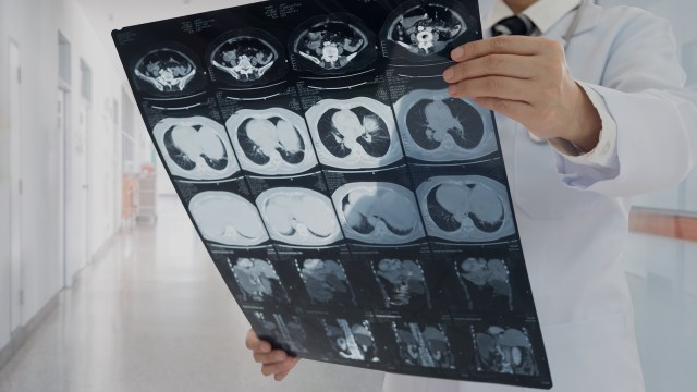 A study has found that the tiniest microplastics can severely compromise kidney health and function.