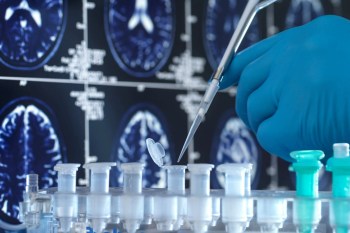 Researchers found more microplastics in the brains of people who had dementia than in those who didn't.