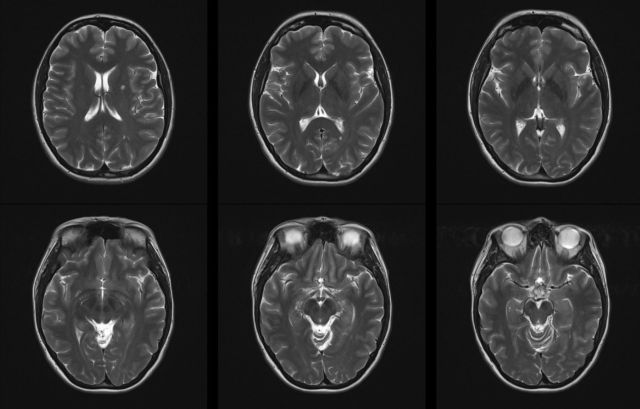 This study provides strong evidence of the association between air pollution and risk of developing MS and severity of MS including relapses, developing active lesions, and disability progression.