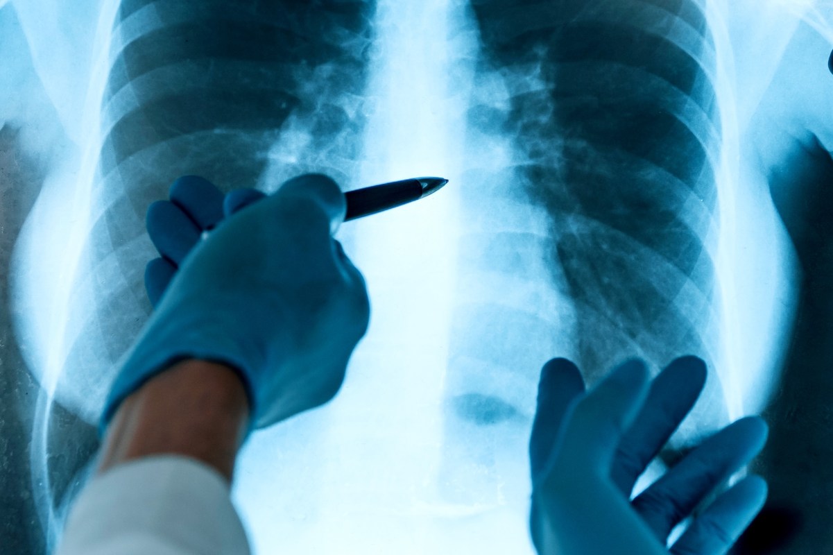 Physicians are sounding the alarm over a common building material — engineered quartz countertops — that has gravely sickened hundreds of young tradespeople.