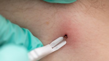 A healthcare professional uses a tick removal tool to extract a tick from a person's skin surface.