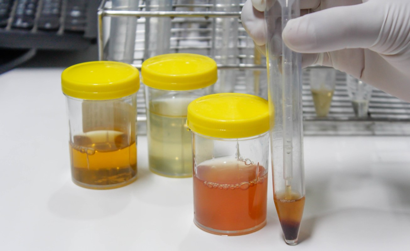 A scientist in gloves is measuring urine samples in jars and a test tube.