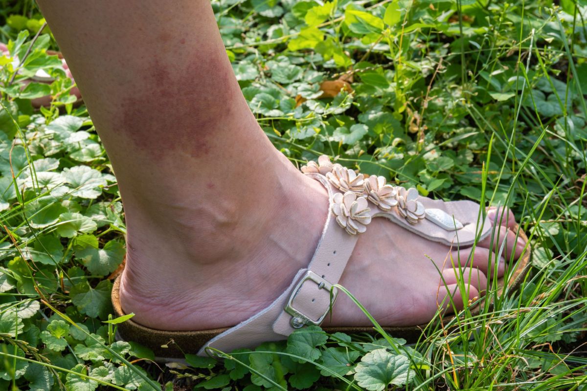 A Lyme disease rash on the ankle of a person with a light skin tone.