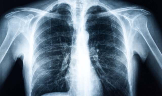 A chest X-ray showing the lungs, heart, and shoulder joints in detail.