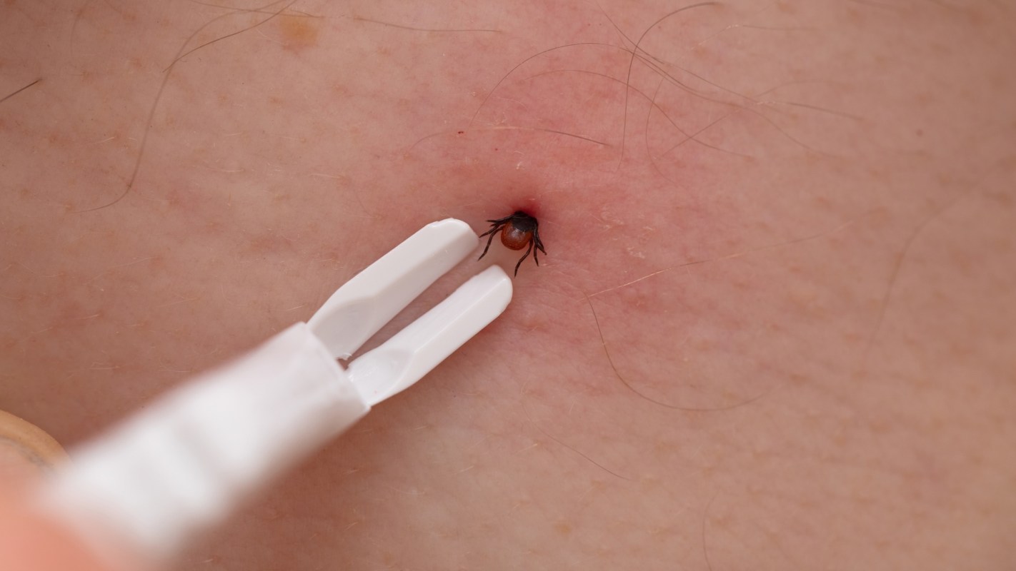 A close-up of a tick being removed from skin using a pair of tweezers.