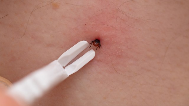 A close-up of a tick being removed from skin using a pair of tweezers.