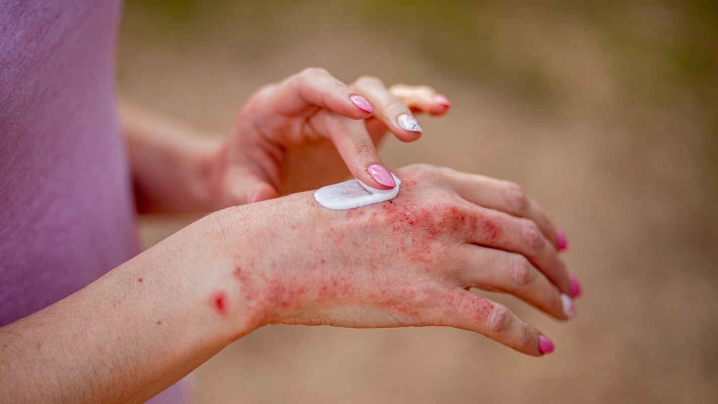 A person applying eczema cream to their hand.