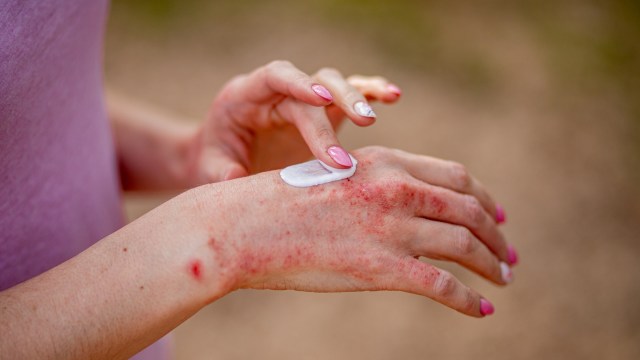A person applying eczema cream to their hand.