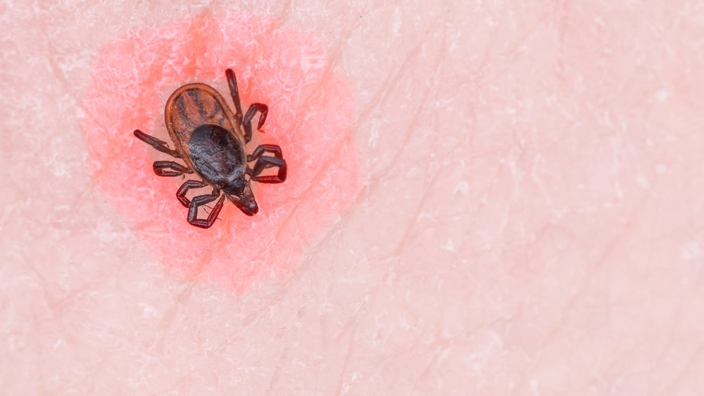 A close-up of a tick embedded in human skin, with a red area around the bite.