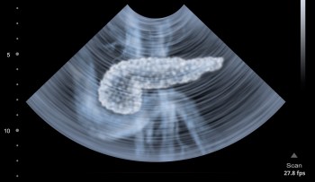 An ultrasound pf a pancreas.