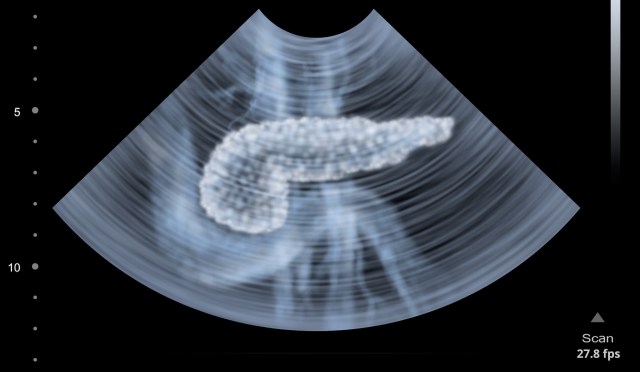 An ultrasound pf a pancreas.