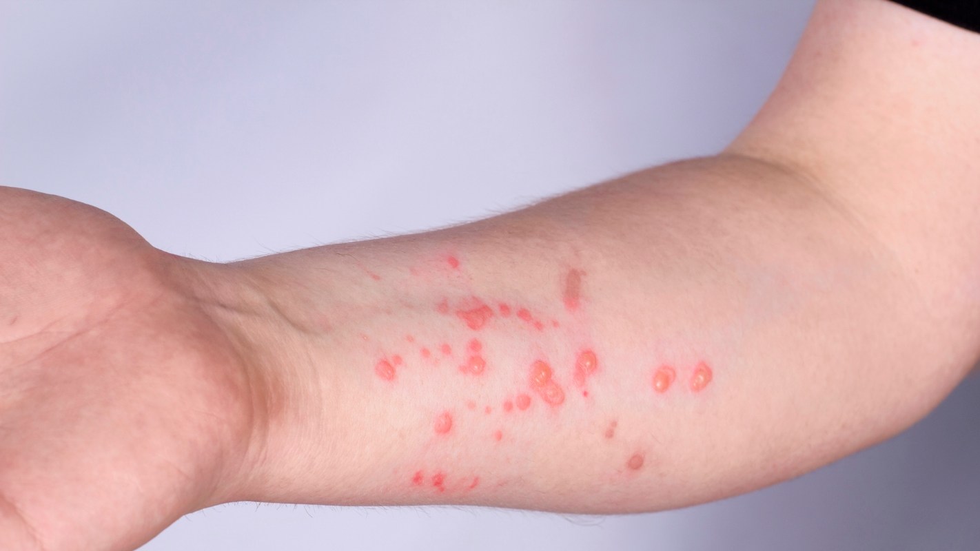 A forearm with red, raised lesions on fair skin.