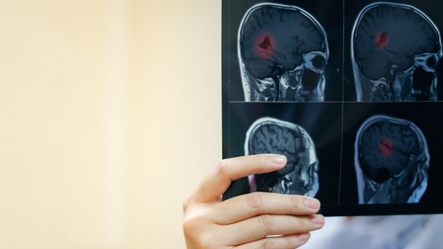 A person holding MRI brain scans showing areas of concern highlighted in red.