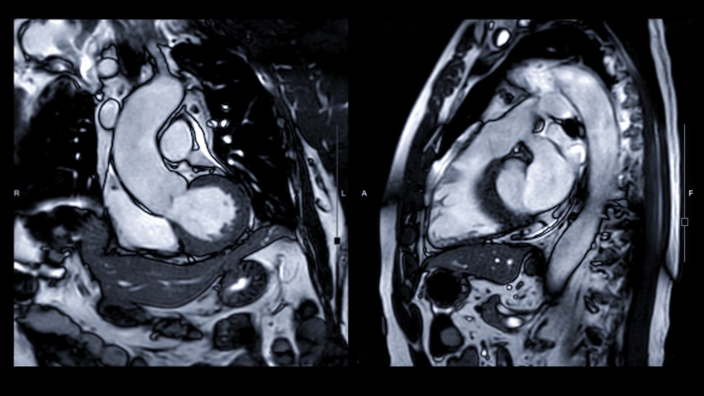 Two side-by-side cardiac MRI images showing the heart's chambers and major vessels in grayscale.