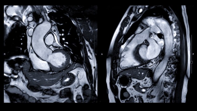Two side-by-side cardiac MRI images showing the heart's chambers and major vessels in grayscale.