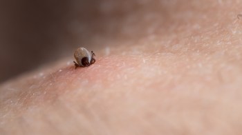 A tick attached to human skin.