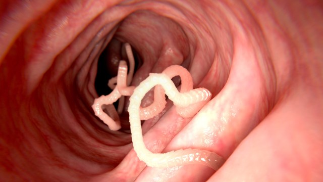 A close-up view of a human intestine featuring several entwined parasitic tapeworms.