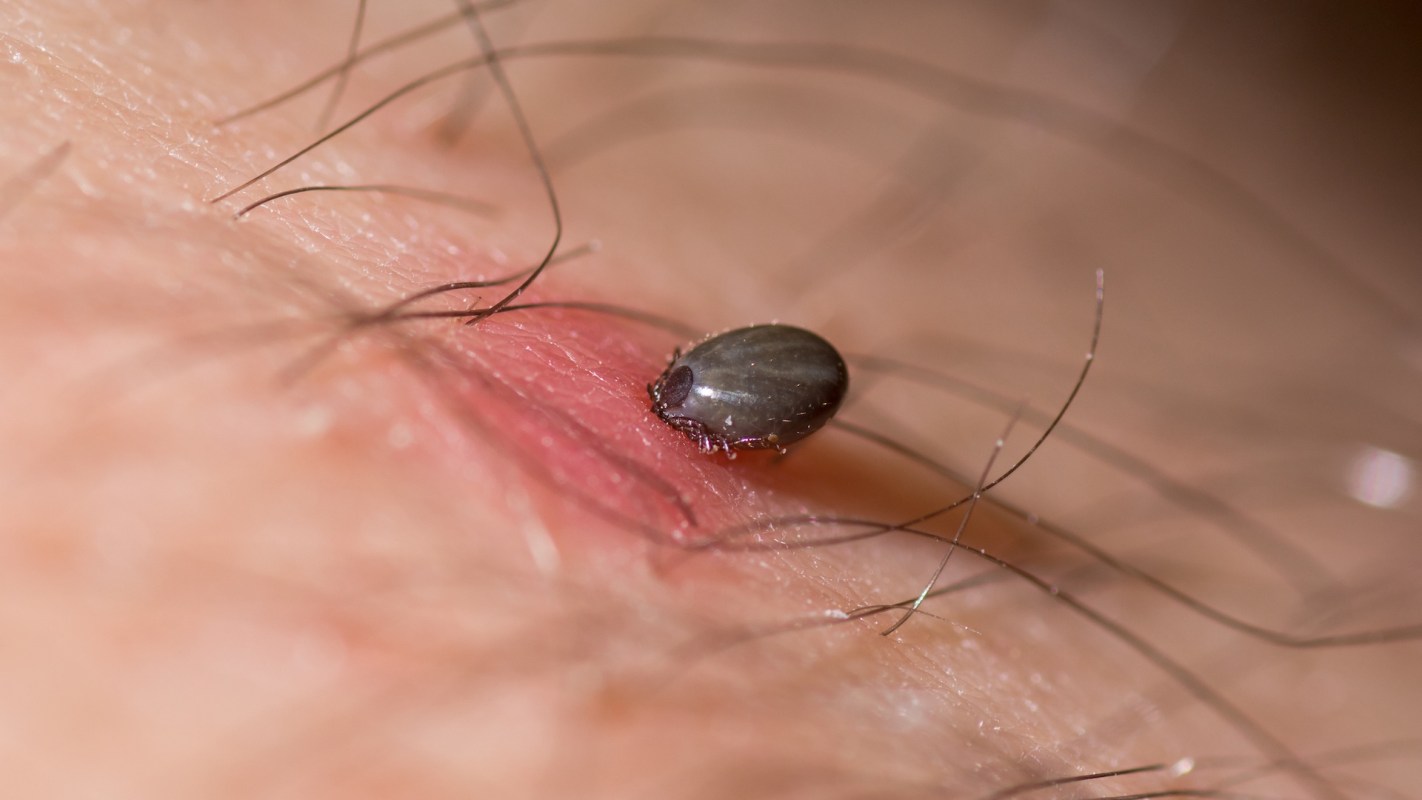 A close-up image of a tick embedded in human skin with fine hair visible around it.