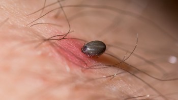 A close-up image of a tick embedded in human skin with fine hair visible around it.
