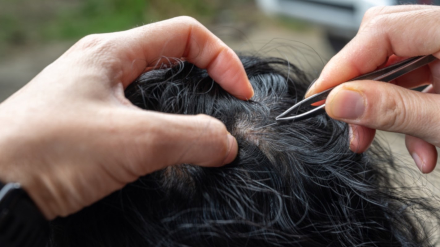 A person uses tweezers to examine someone's scalp.