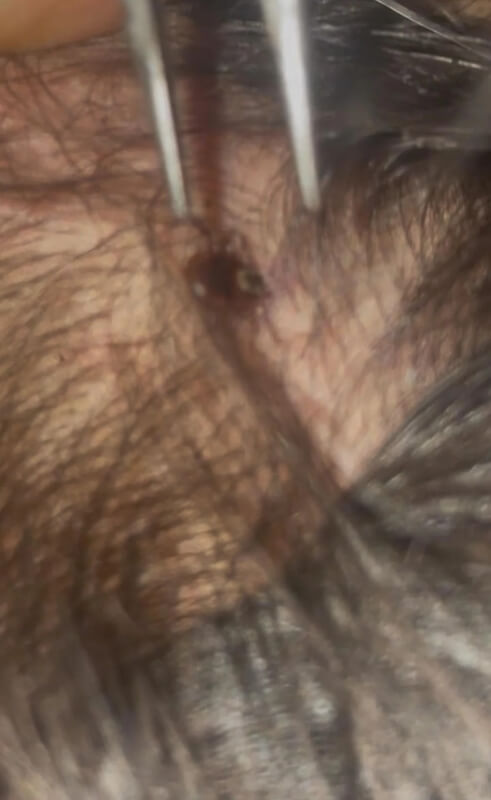 A black bug attached to someone's scalp.