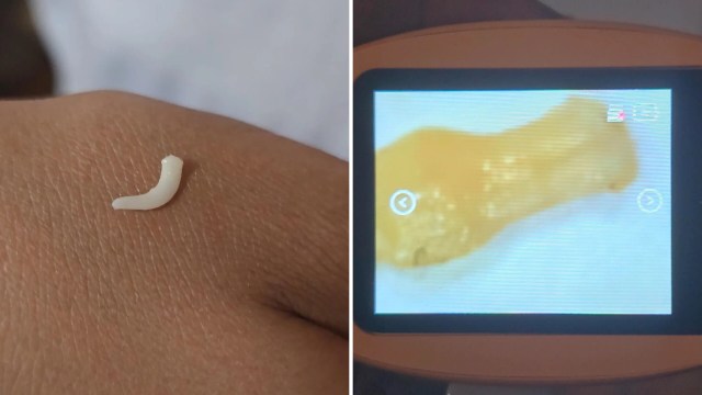 A close-up of a white object resembling a white tapeworm observed on skin, alongside a digital screen displaying it.