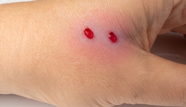 A close-up of a hand with two droplets of blood on the skin, surrounded by slight redness.