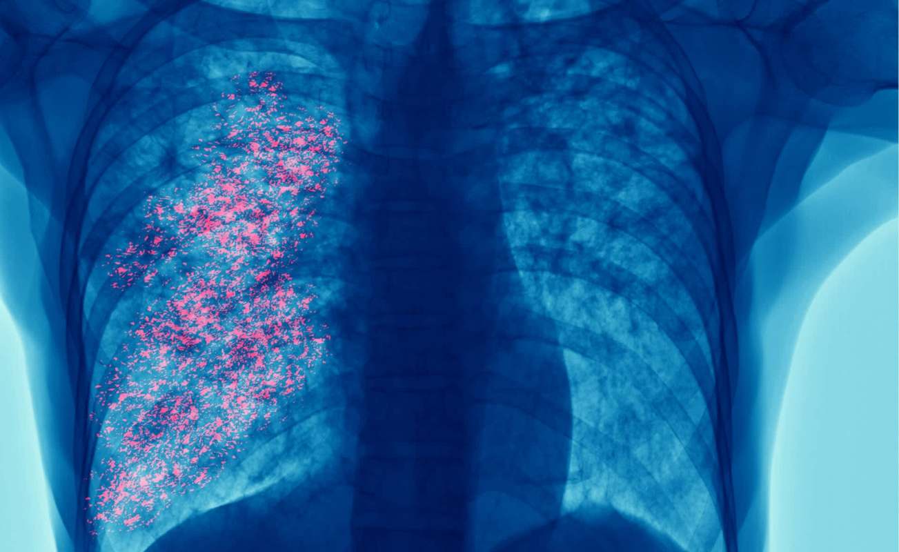 A digital X-ray of the chest and lungs.