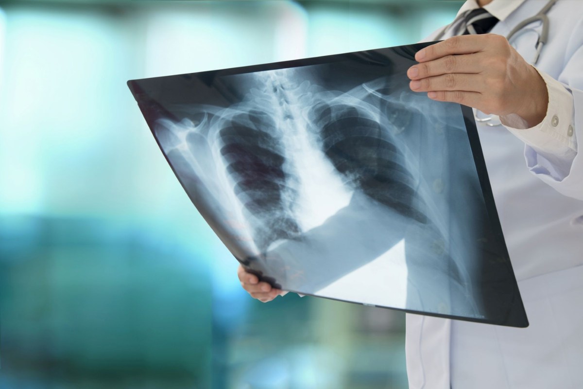 A person looking at an x-ray.