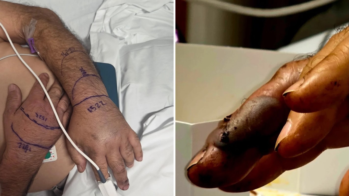 Snake bites on a person's hands.