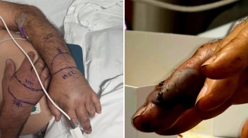 Snake bites on a person's hands.