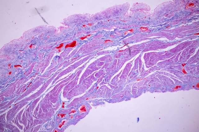 A microscopic view of tissue displaying various shades of purple and red with distinct cellular structures.