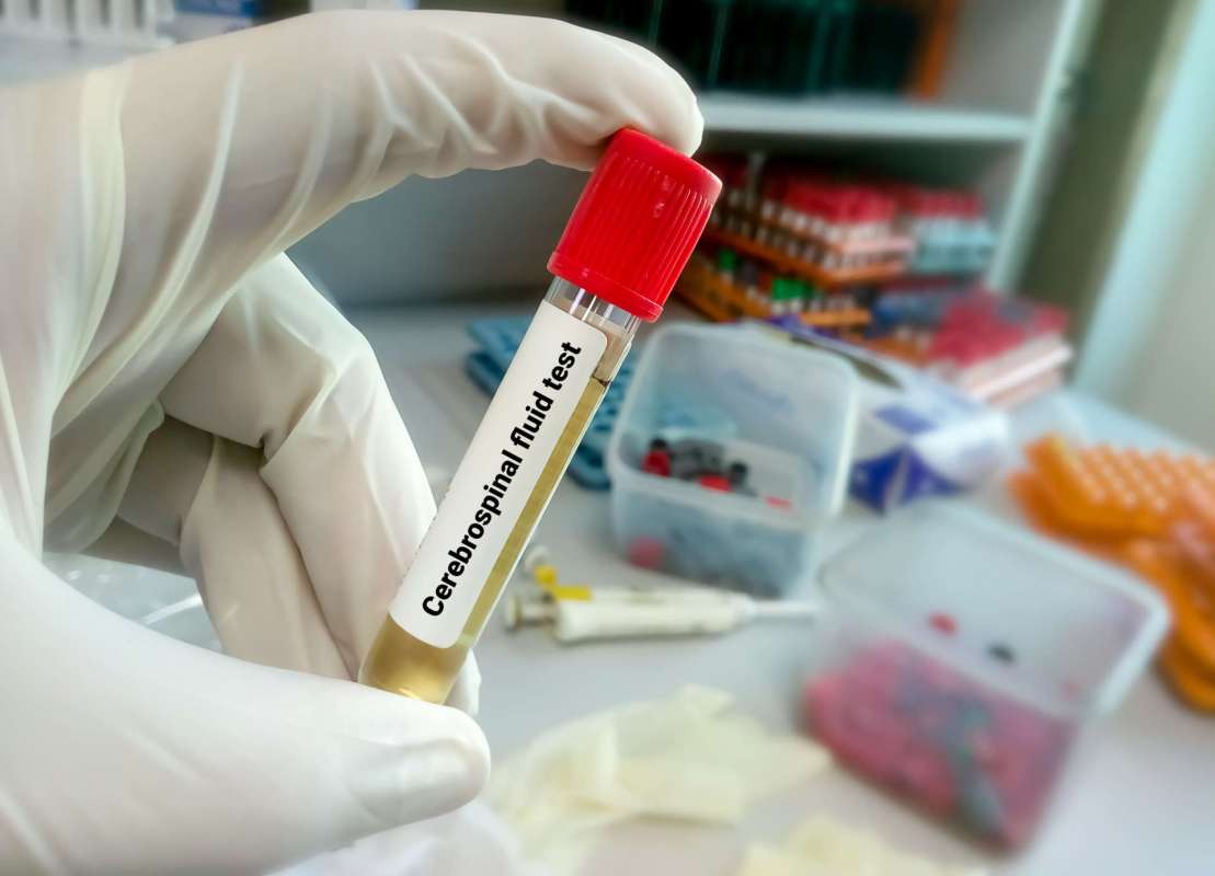 A hand in a glove holds a test tube labeled “Cerebrospinal fluid test” filled with yellow liquid.