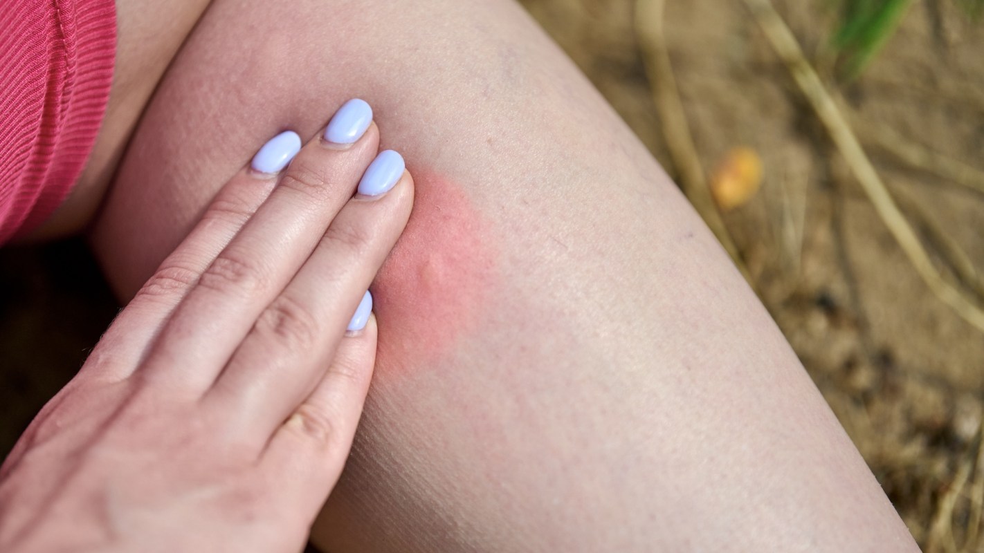 A hand gently touches a red mark on a leg in an outdoor setting.