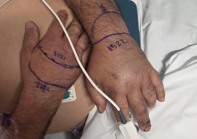 A person's hands with snake bites.